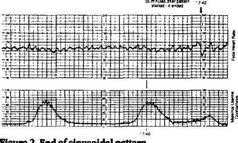 Figure 2 from Sinusoidal Fetal Heart Rate Pattern After Administration ...