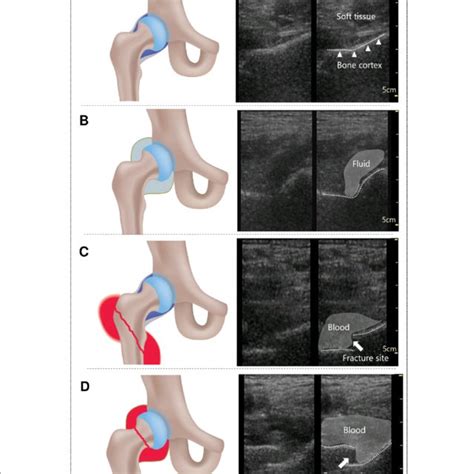 How to Perform Hip Ultrasound 的图像结果