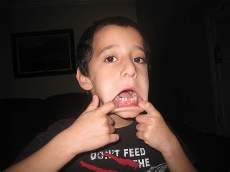 Image result for Lost Tooth