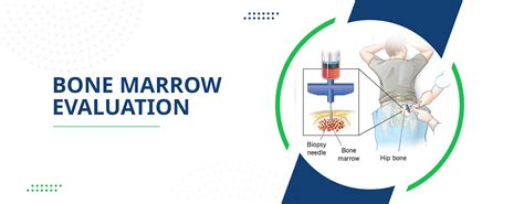 Bone Marrow Testing 的图像结果