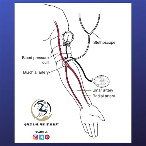 Placement of blood pressure cuff and stethoscope for monitoring brachial artery blood pressure ...