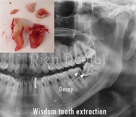 Extracted Wisdom Tooth 的图像结果