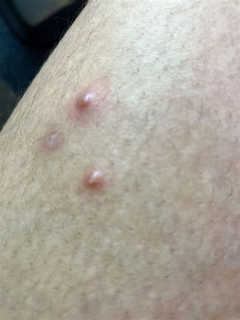 Pimple like spots on thighs : r/DermatologyQuestions