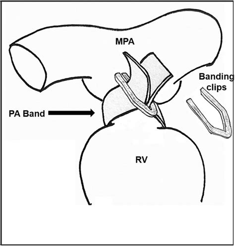 Frontiers | Pulmonary artery debanding in the cath lab: Lessons learned!