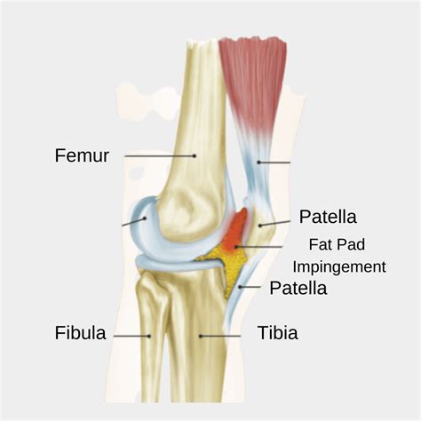 Knee Fat Pad: Anterior Knee Pain Impingement | Hoffa's Fat Pad