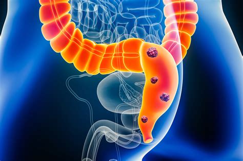 Colorectal cancer rise in young may be from fungus