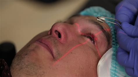 Corneal Cross Linking Procedure | Buena Vista Laser Center | El Paso, TX