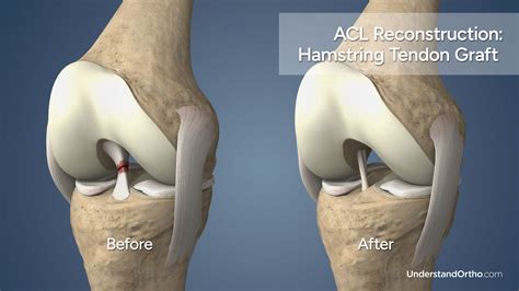 Torn ACL Reconstruction (Hamstring Graft) – UnderstandOrtho™