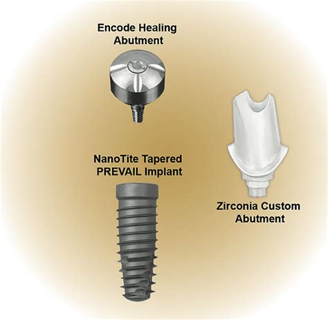 Top Rated Dental Implants | Best In Class Dental Implants ...