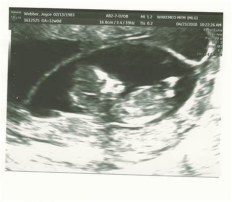 Ash & Lee Plus 3: 12 Week Ultrasound