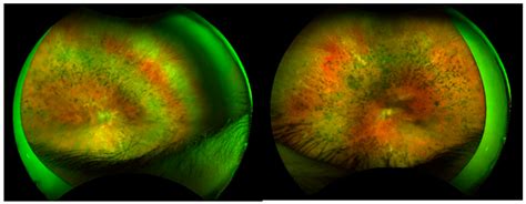 Retinal Dystrophies Associated with Mutations in the RP1 Gene: Genotype ...