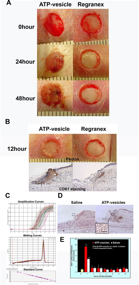 Granulation Tissue Wound