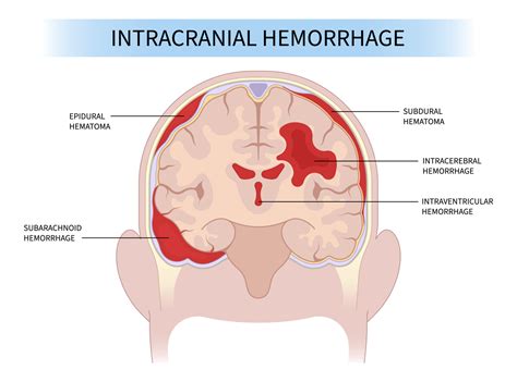 What Is a Hematoma? Types of Hematomas in the Brain