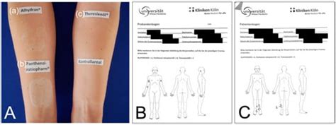 Which Moisturizer to Use in Scar Therapy after Burn Injuries? A ...