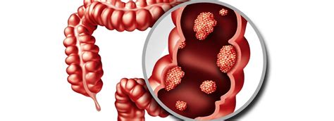 Image result for Appendix Cancer Symptoms