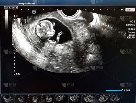 孩子怀孕12周时的照片。超声波过程。前三个月的筛查。