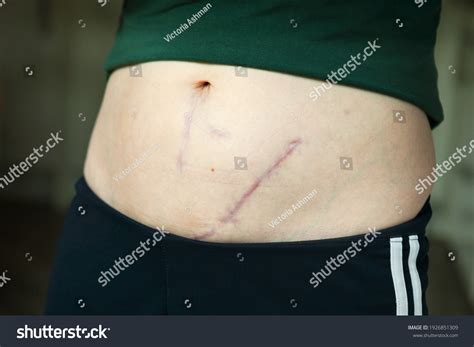 Scars Kidney Transplant Peritoneal Dialysis Exit Stock Photo 1926851309 ...