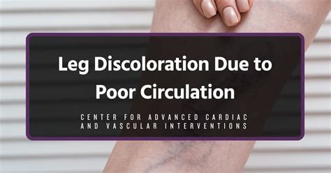 Image result for Leg Circulation Problems Symptoms