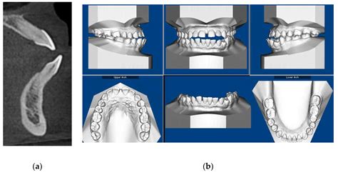 The Use of High Frequency Vibration and Clear Aligners in Management of ...