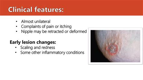 Paget's disease | PPTX