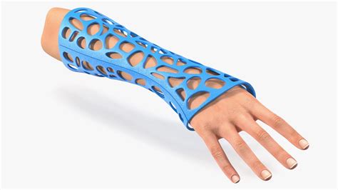 3D-Printed Orthopedic Cast On Hand 3D Model $69 - .3ds .blend .c4d .fbx ...
