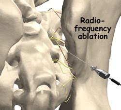 si joint injection - Preferredpaincenter