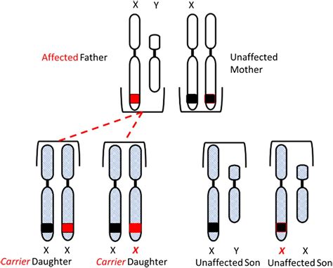 Hemophilia | American Society for Clinical Laboratory Science
