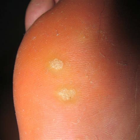 Can You Recognize Plantar Warts on Feet?