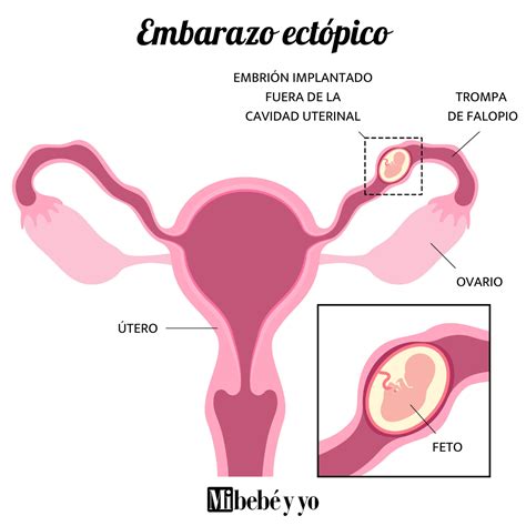 Que Un Embarazo Ectopico