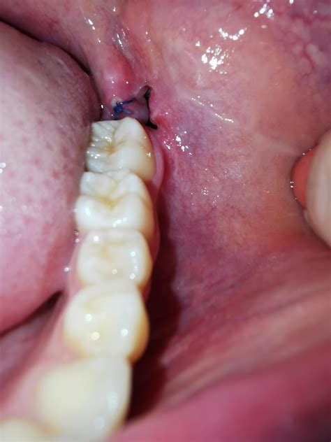 Image result for Infected Tooth Extraction Aftercare