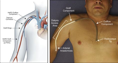 Tunneled Dialysis Catheter