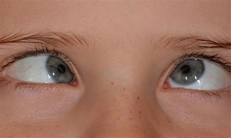 Refractive error main reason behind squinting