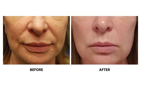 Threading Face Before And After Thread Lift Before And After | Kaado