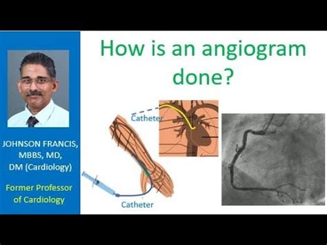 Image result for How Angiogram Is Done