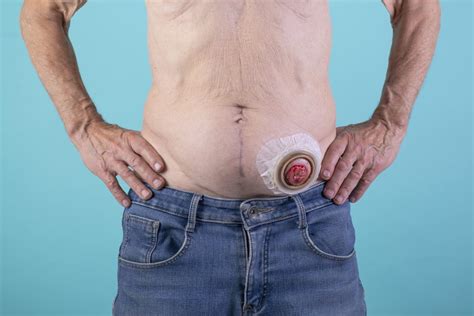 Image result for Apr Resection Surgery