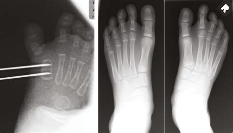 View of Physiolysis for Metatarsal Bracketed Epiphysis | Journal of the ...