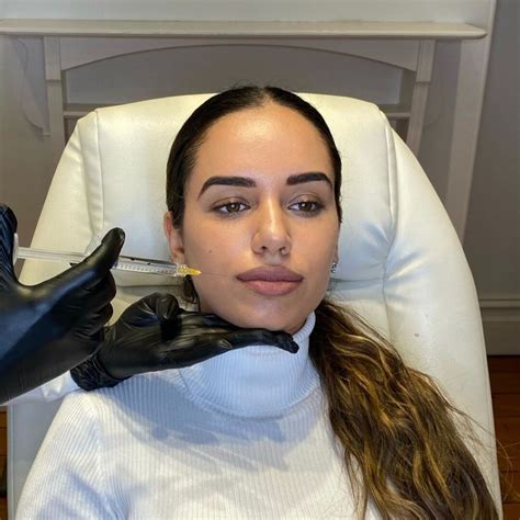 Lip Filler Aftercare: 7 Must-Know Tips for Beautifully Plump Lips!