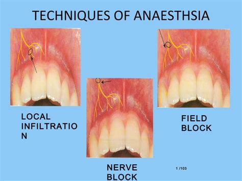 Local Anesthesia Examples 的图像结果