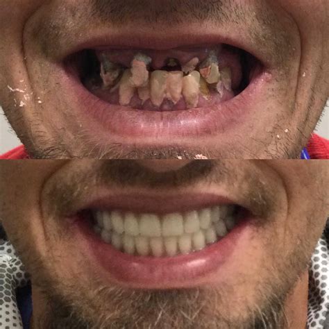 Image result for Immediate Dentures Procedure