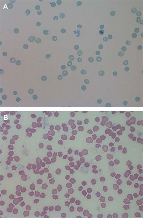 Image:Cuerpos de Heinz, gato-Manual de veterinaria de Merck