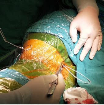 腰大池腹腔分流（LPS）手术实例 （细节图文版）