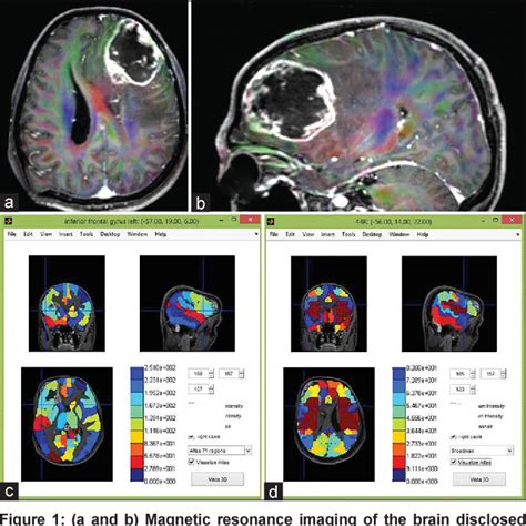 Image result for Language Mapping Awake