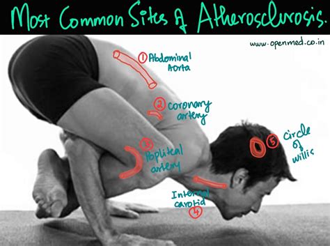 Most Common Sites of Atherosclerosis (visual mnemonic)