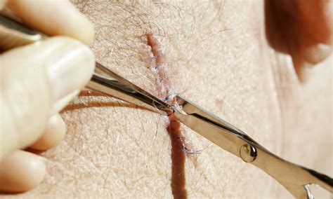 Removing Sutures Step by Step 的图像结果