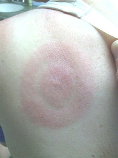 bullseye lyme disease