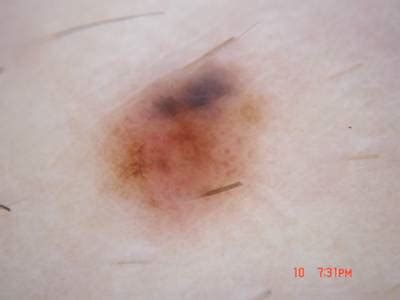 ISIC Challenge 2018 - Dataset Ninja