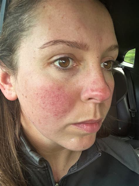 Red face during pregnancy made mum cry, until she found the cure ...