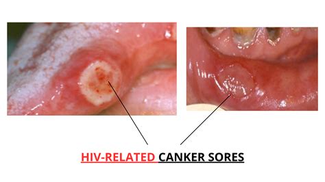 HIV Mouth Sores: A Complete Visual Guide with Pictures