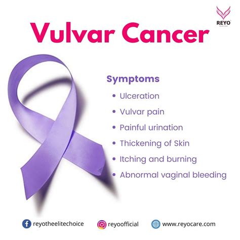 Vulvar cancer symptoms – Artofit