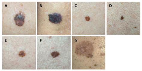 Over-Detection of Melanoma-Suspect Lesions by a CE-Certified Smartphone ...